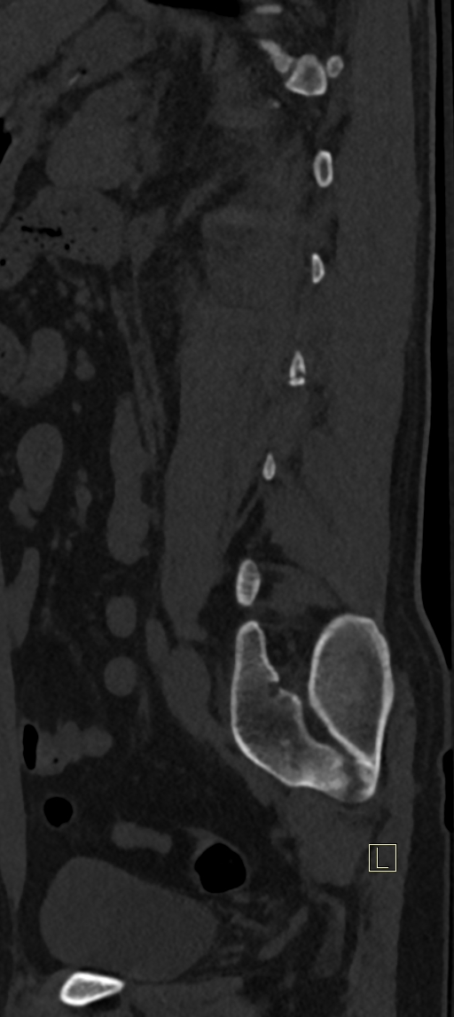 Calcaneal fractures with associated L2 burst fracture (Radiopaedia 71671-82493 Sagittal bone window 14).jpg