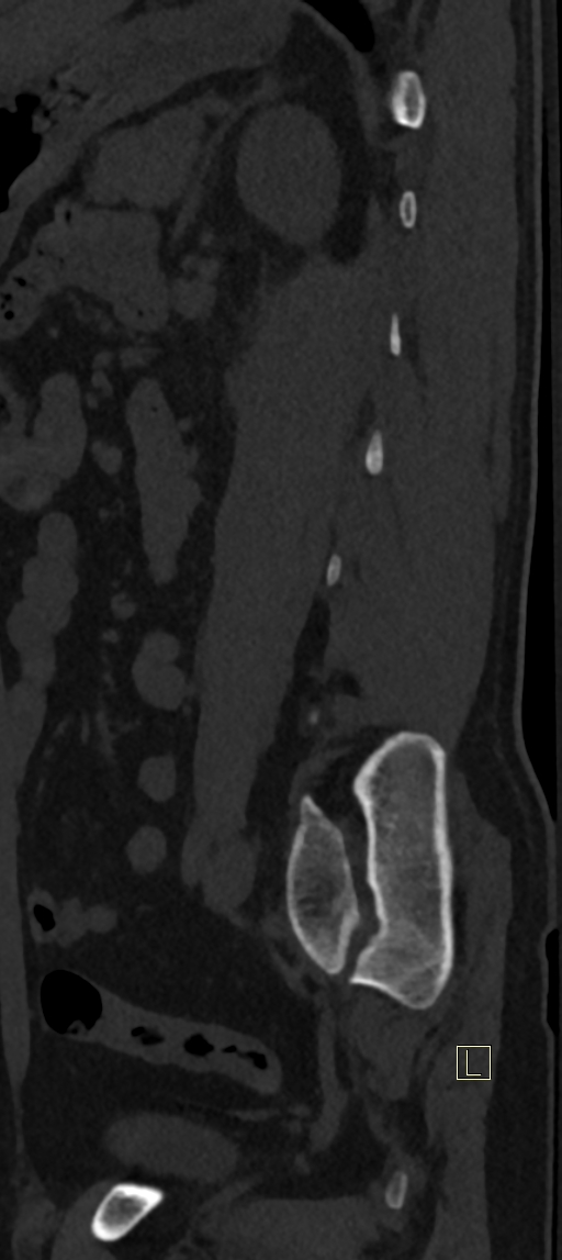 Calcaneal fractures with associated L2 burst fracture (Radiopaedia 71671-82493 Sagittal bone window 9).jpg