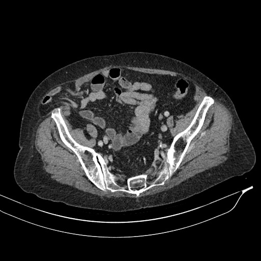 Calcified adrenal glands and Spigelian hernia (Radiopaedia 49741-54988 A 188).jpg