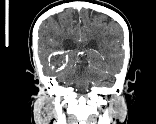 File:Calcified cerebral hydatid cyst (Radiopaedia 65603-74717 C 47).jpg