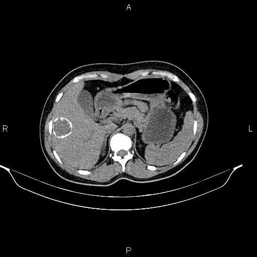 File:Calcified hepatic hydatid cyst (Radiopaedia 84672-100095 Axial non-contrast 28).jpg