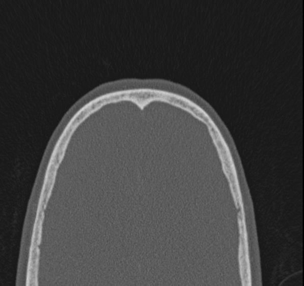 Caldwell-Luc operation (Radiopaedia 52329-58225 Axial bone window 3).jpg