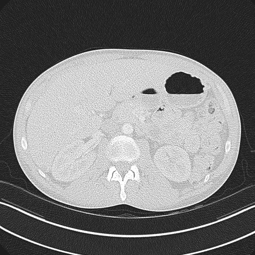 Cannonball metastases - testicular choriocarcinoma (Radiopaedia 84510-99891 Axial lung window 107).jpg