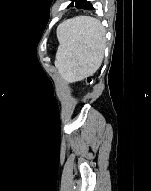 Caput medusae sign - portal hypertension (Radiopaedia 64007-72759 B 82).jpg