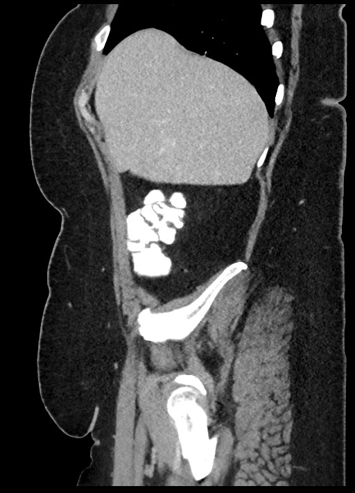 Carcinoid tumor - terminal ileum (Radiopaedia 60931-68739 C 85).jpg