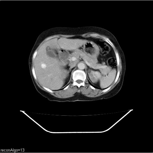 Carcinoma cervix- recurrence (Radiopaedia 34702-36137 B 14).jpg