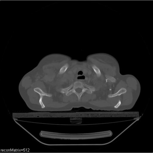 File:Carcinoma of esophagus (Radiopaedia 27356-27550 Axial bone window 30).jpg