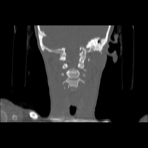 Carcinoma of the maxillary antrum (Radiopaedia 53805-59888 Coronal bone window 101).jpg