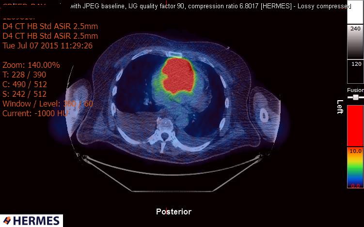 File:Cardiac lymphoma (Radiopaedia 38690-40871 Integrated PET-CT 12).jpg