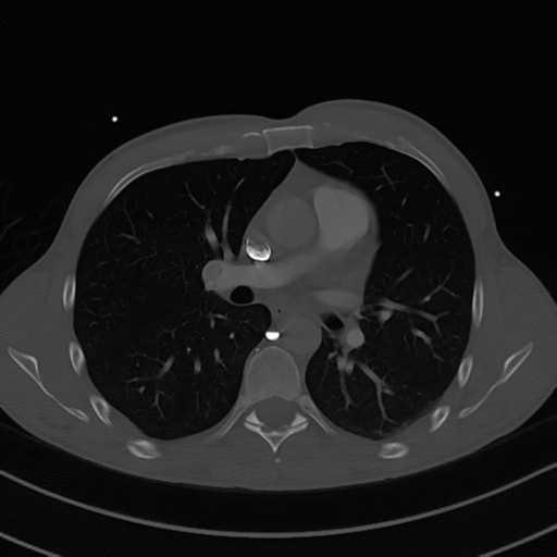 Cardiac tumor - undifferentiated pleomorphic sarcoma (Radiopaedia 45844-50134 Axial bone window 32).png