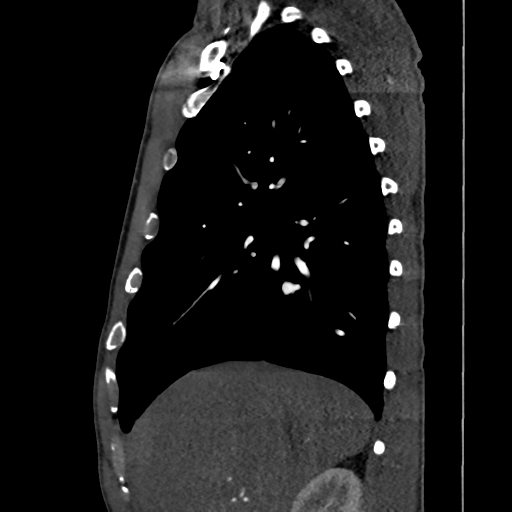 Cardiac tumor - undifferentiated pleomorphic sarcoma (Radiopaedia 45844-50134 B 58).png