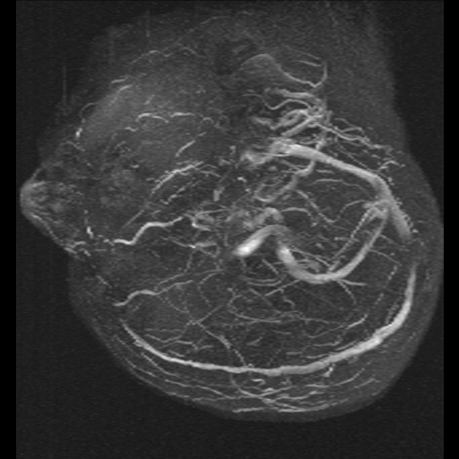 Carotid arterial dissection with acute cerebral infarction (Radiopaedia 26636-26784 MRV 16).jpg