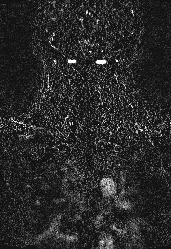 File:Carotid artery dissection (Radiopaedia 28441-28689 Coronal MRA 86).jpg