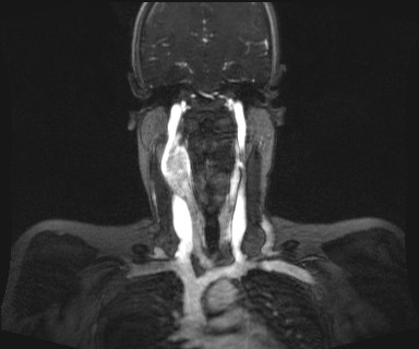 File:Carotid body tumor (Radiopaedia 12777-12912 MRA 35).jpg