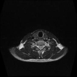 File:Carotid body tumor (Radiopaedia 30208-30823 Axial T2 1).jpg
