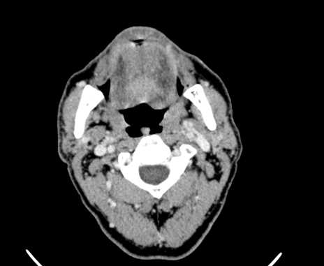 Carotid body tumor (Radiopaedia 61750-69757 Axial Post contrast 28).jpg