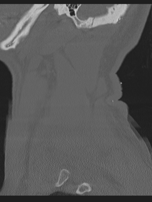 Cavernoma of cervical cord (Radiopaedia 50838-56346 Sagittal bone window 71).png