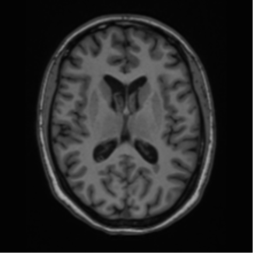 Cavernoma with bleed - midbrain (Radiopaedia 54546-60774 Axial T1 26).png