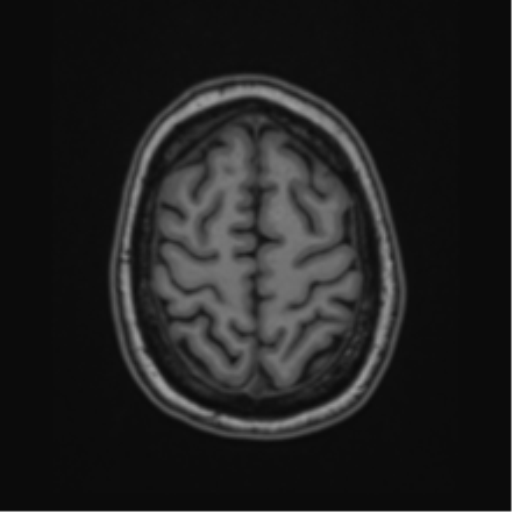 Cavernoma with bleed - midbrain (Radiopaedia 54546-60774 Axial T1 47).png