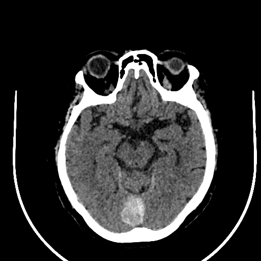 Cavernous hemangioma of the cerebellar falx (Radiopaedia 73025-83723 Axial non-contrast 55).jpg