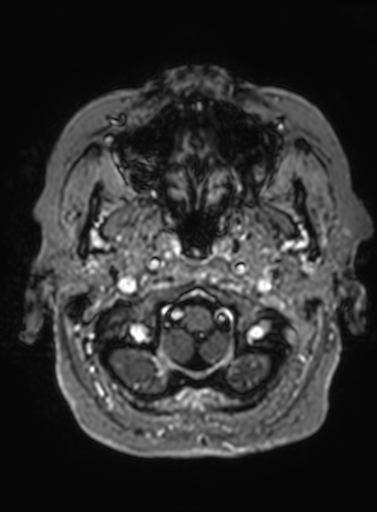 Cavernous hemangioma of the cerebellar falx (Radiopaedia 73025-83724 Axial T1 C+ 313).jpg