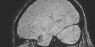 Cavernous hemangioma of the cerebellar falx (Radiopaedia 73025-83724 Sagittal BOLD 149).jpg
