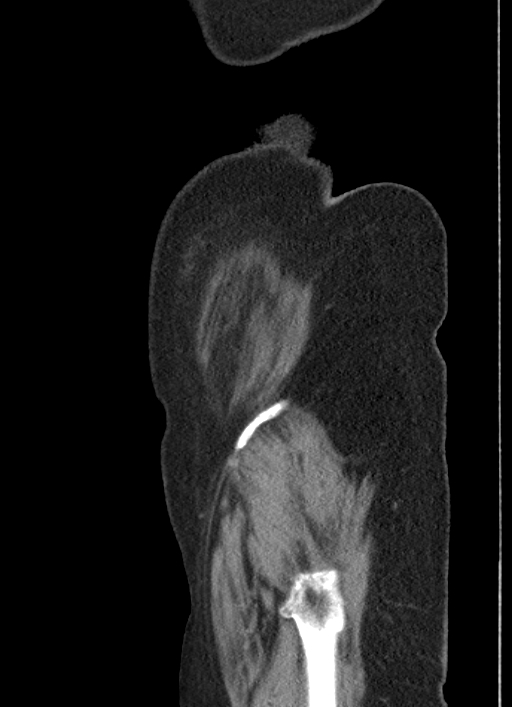 Cecal adenocarcinoma - surgical scar recurrence (Radiopaedia 79988-93264 D 63).jpg
