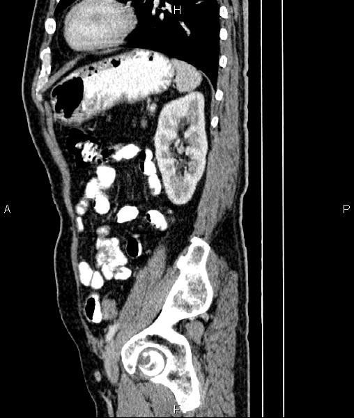 File:Cecal cancer with appendiceal mucocele (Radiopaedia 91080-108651 E 71).jpg