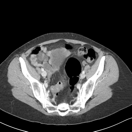 Cecal internal hernia through the foramen of Winslow (Radiopaedia 44820-48651 B 61).png