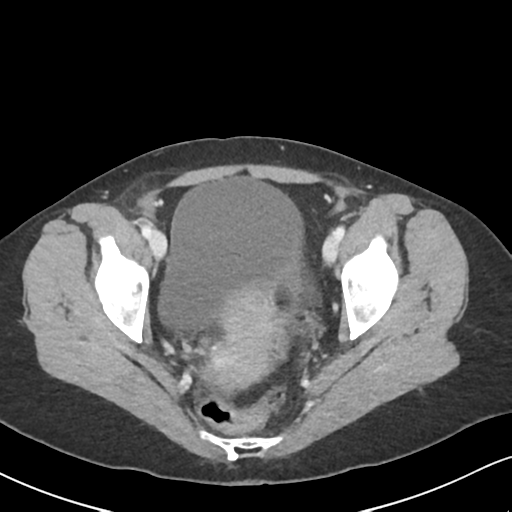 Cecal internal hernia through the foramen of Winslow (Radiopaedia 44820-48651 B 68).png