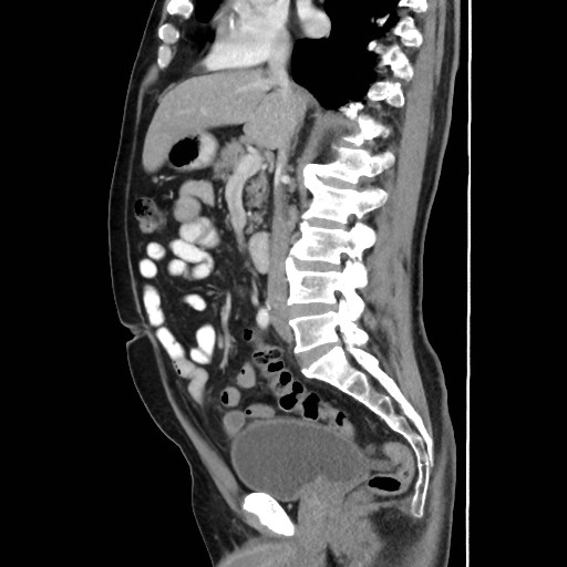 Cecal mass causing appendicitis (Radiopaedia 59207-66531 C 30).jpg