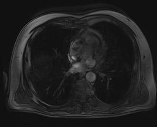 Cecal mass causing appendicitis (Radiopaedia 59207-66532 K 4).jpg