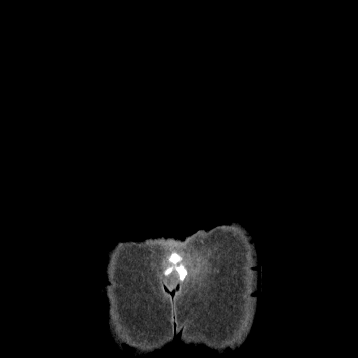 Cecal volvulus (Radiopaedia 69527-79408 B 76).jpg