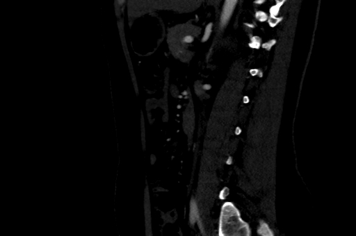 Celiac artery compression syndrome (Radiopaedia 47538-52152 B 65).jpg