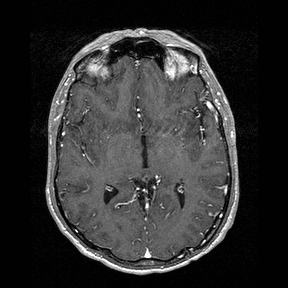 Central-variant posterior reversible encephalopathy syndrome (PRES) (Radiopaedia 43880-47358 Axial T1 C+ 76).jpg