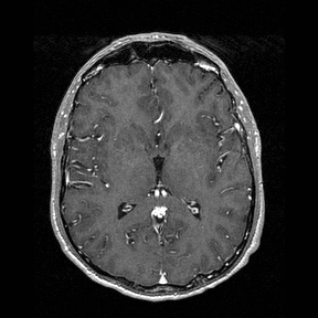 File:Central-variant posterior reversible encephalopathy syndrome (PRES) (Radiopaedia 43880-47358 Axial T1 C+ 84).jpg