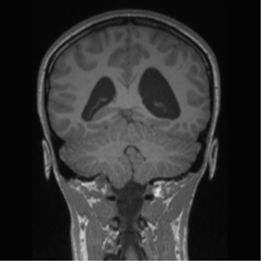 Central neurocytoma (Radiopaedia 37664-39557 Coronal T1 31).png