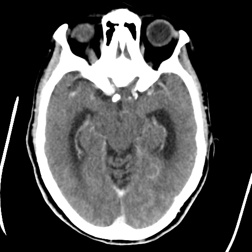 Central neurocytoma (Radiopaedia 65317-74346 Axial C+ delayed 20).png