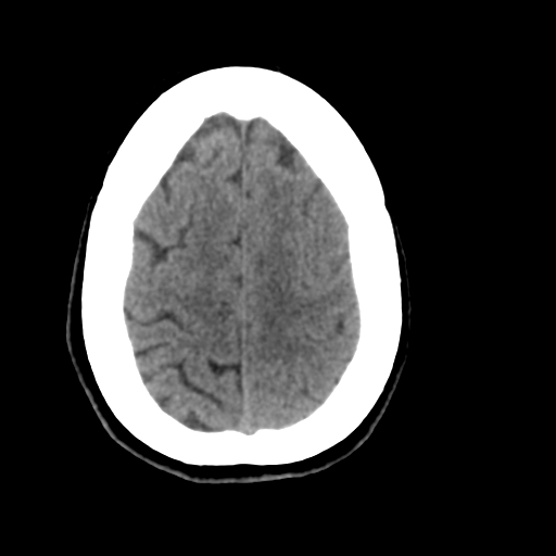 Central neurocytoma (Radiopaedia 65317-74346 Axial non-contrast 41).png