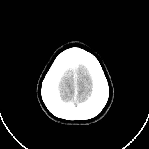 Central neurocytoma (Radiopaedia 84497-99871 Axial non-contrast 50).jpg
