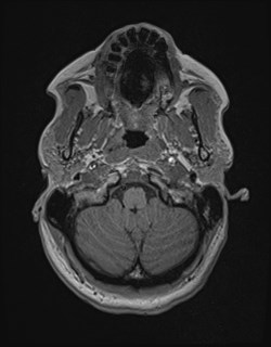 File:Central neurocytoma (Radiopaedia 84497-99872 Axial T1 35).jpg
