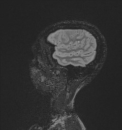 Central neurocytoma (Radiopaedia 84497-99872 Sagittal Flair + Gd 29).jpg
