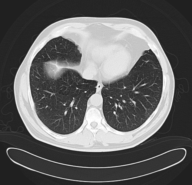 Centrilobular pulmonary emphysema (Radiopaedia 26808-26971 C 33).jpg