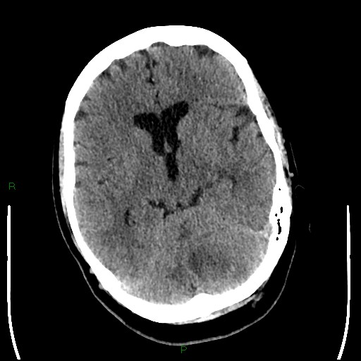 Cerebellar abscess (Radiopaedia 78135-90671 Axial non-contrast 49).jpg