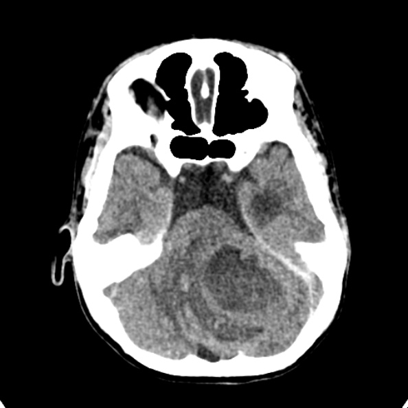Cerebellar abscess secondary to mastoiditis (Radiopaedia 26284-26412 Axial non-contrast 45).jpg