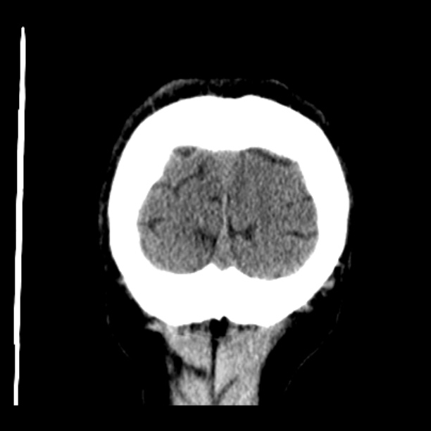 Cerebellar hemorrhage (Radiopaedia 27193-27359 Coronal non-contrast 53).jpg
