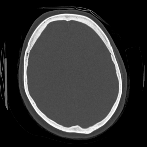 Cerebellar metastasis (cystic appearance) (Radiopaedia 41395-44258 Axial bone window 45).png