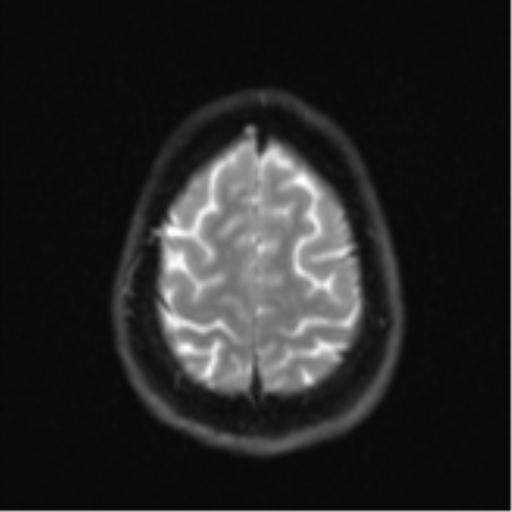Cerebellar metastasis - adenocarcinoma lung (Radiopaedia 63184-71715 Axial DWI 26).png