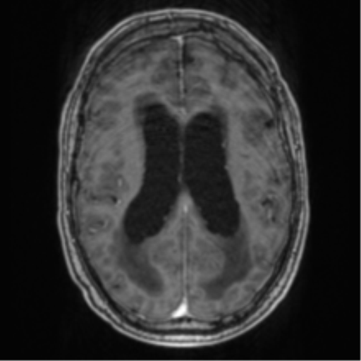 Cerebellar metastasis from lung adenocarcinoma (Radiopaedia 86690-102829 Axial T1 C+ 50).png