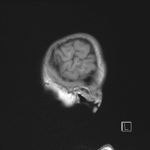 Cerebellar stroke (Radiopaedia 32202-33150 Sagittal T1 C+ 50).png